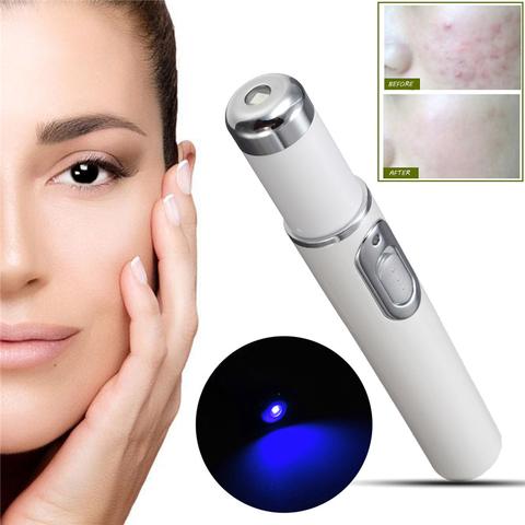 Blue Light Therapy Acne